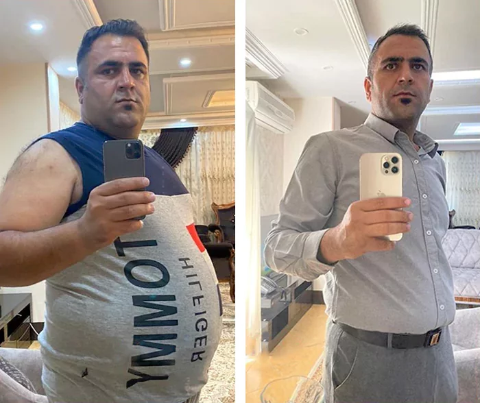 before & after photo of اسلیو معده