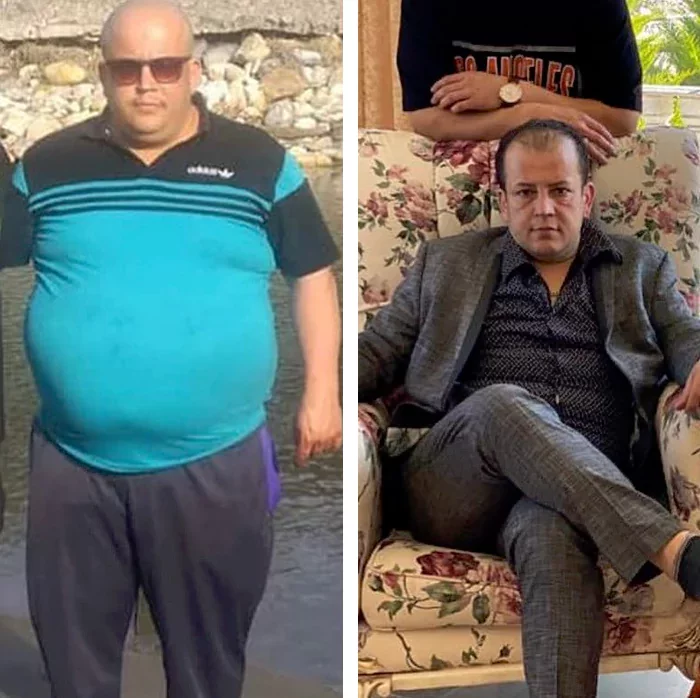 before & after photo of اسلیو معده