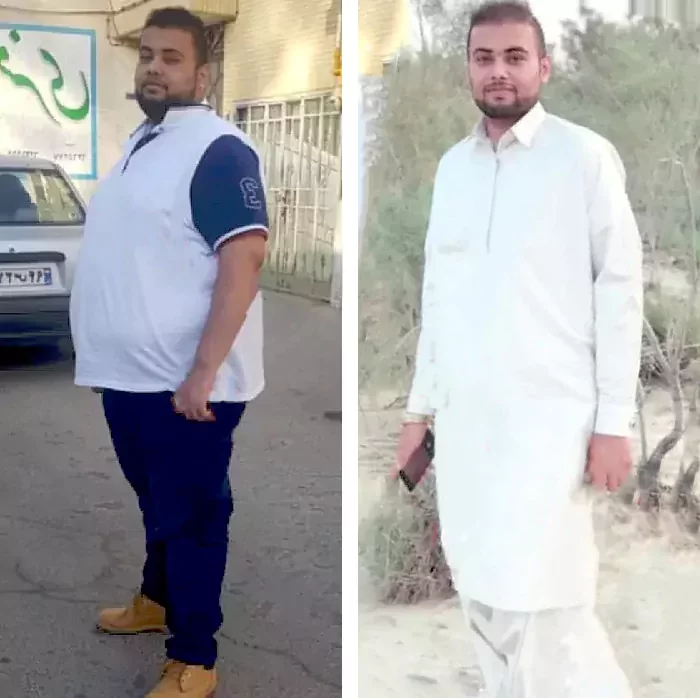 before & after photo of اسلیو معده