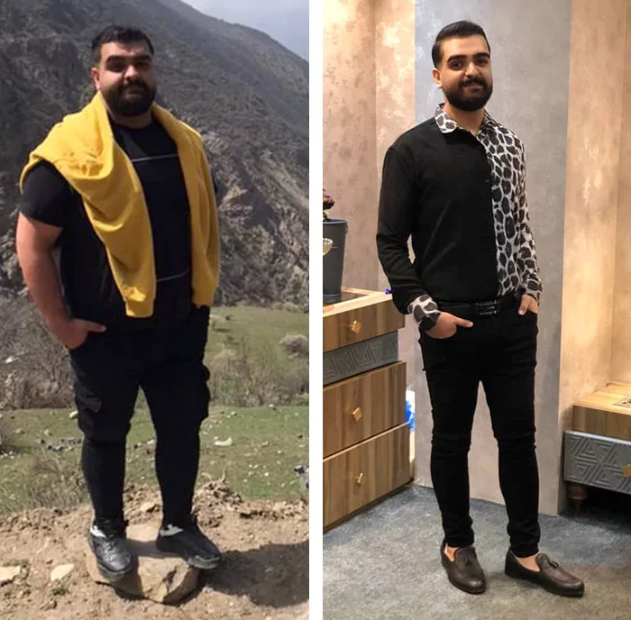 before & after photo of اسلیو معده