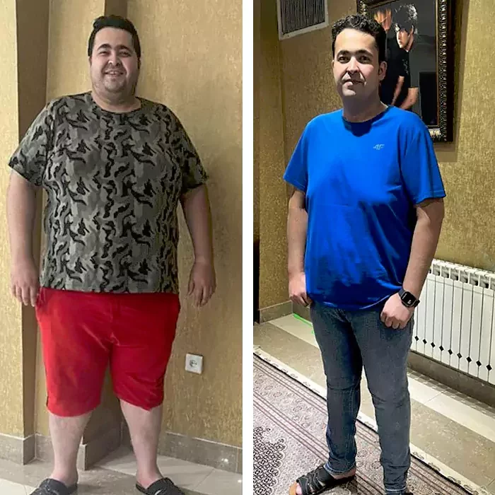 before & after photo of اسلیو معده