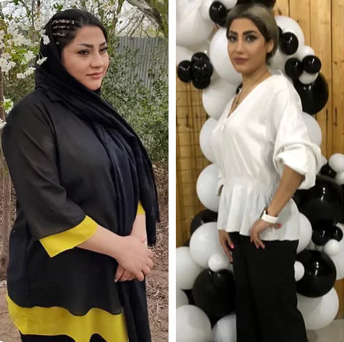 before & after photo of اسلیو معده