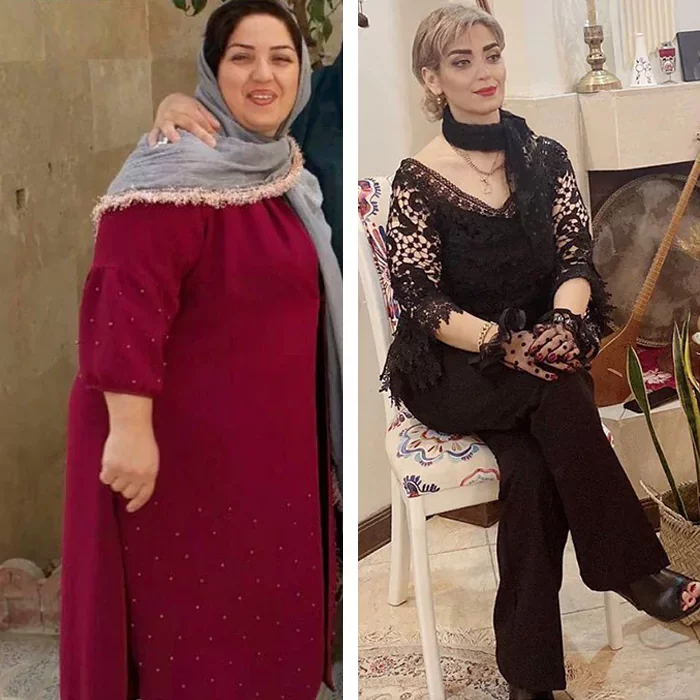 before & after photo of اسلیو معده