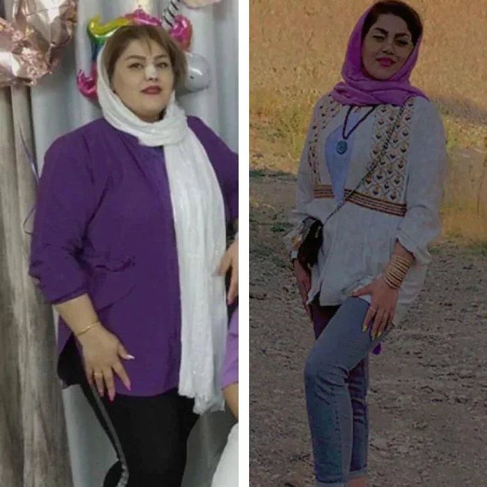 before & after photo of اسلیو معده