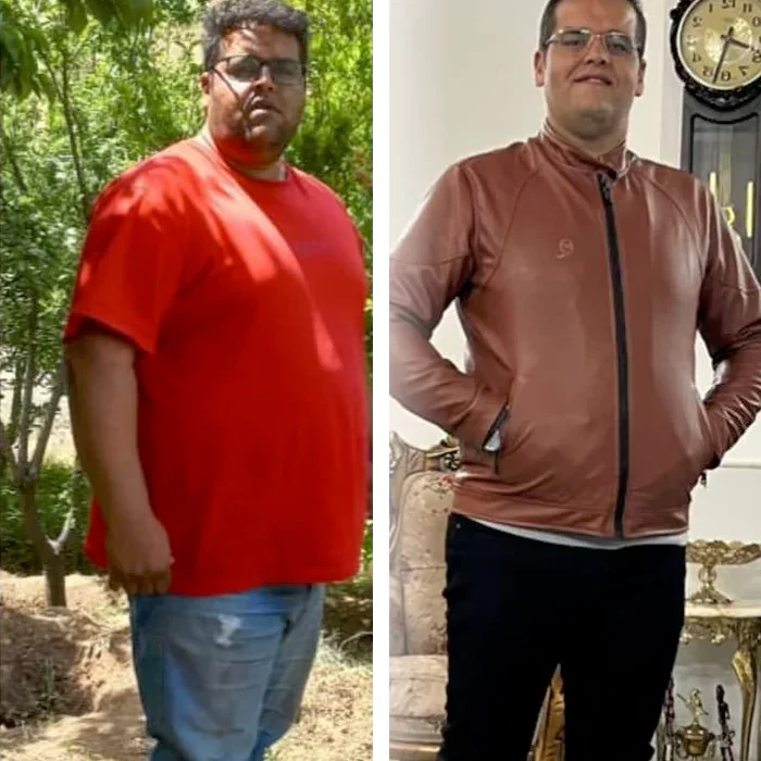 before & after photo of اسلیو معده