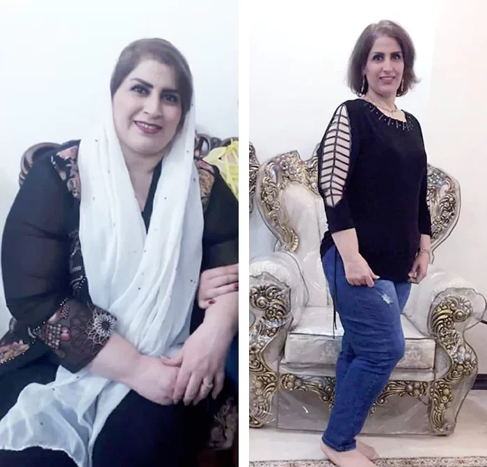 before & after photo of اسلیو معده