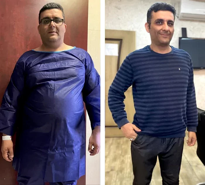 before & after photo of اسلیو معده