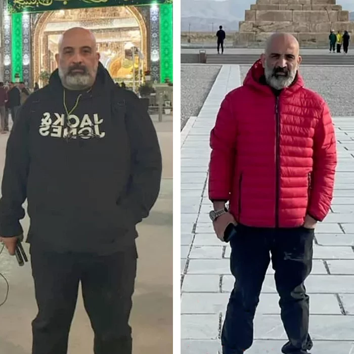 before & after photo of اسلیو معده