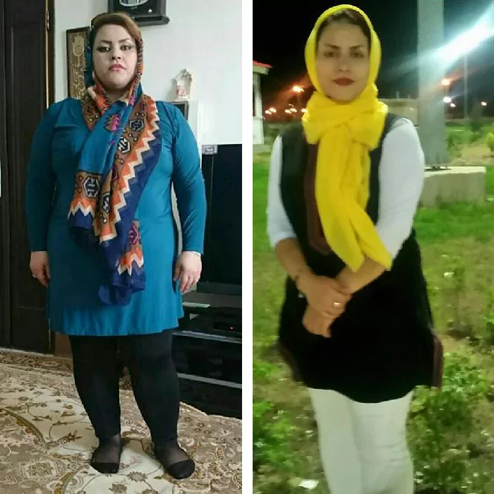 before & after photo of اسلیو معده