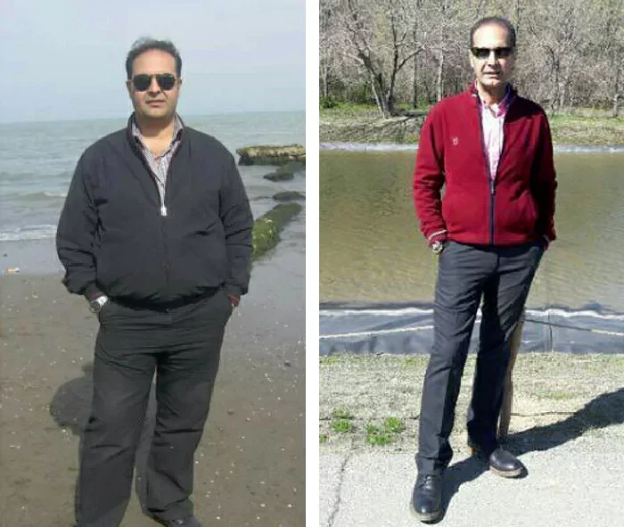 before & after photo of اسلیو معده