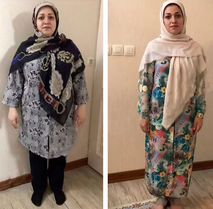 before & after photo of اسلیو معده