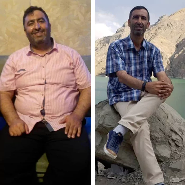 before & after photo of اسلیو معده