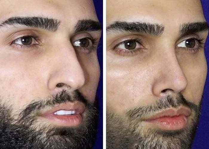 before & after photo of عمل زیبایی بینی