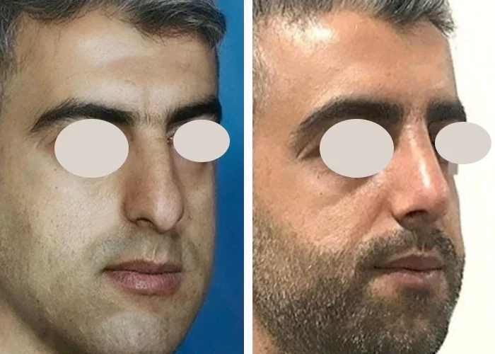 before & after photo of عمل زیبایی بینی