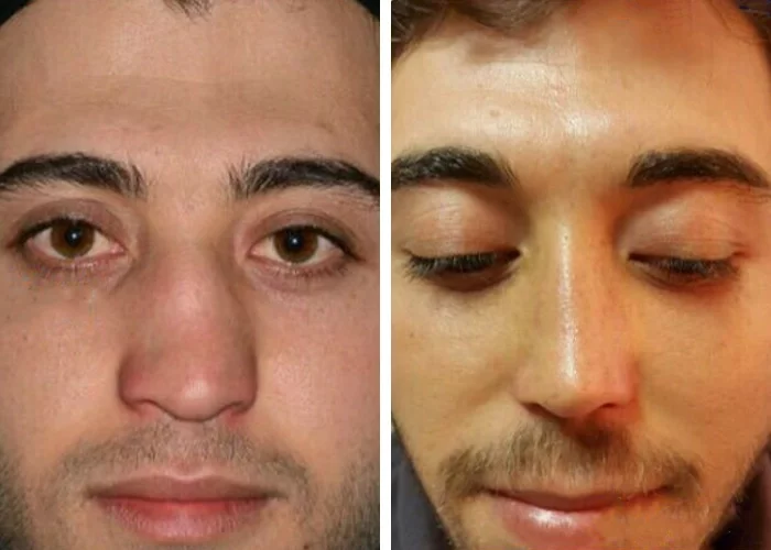 before & after photo of عمل زیبایی بینی