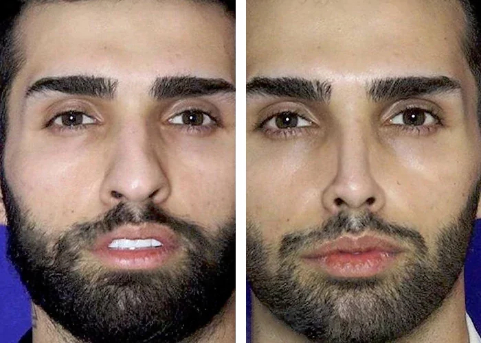 before & after photo of عمل زیبایی بینی