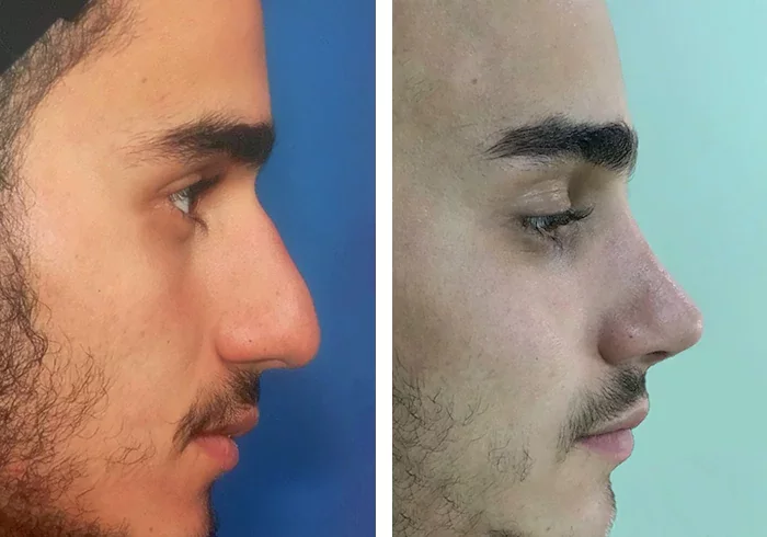 before & after photo of عمل زیبایی بینی