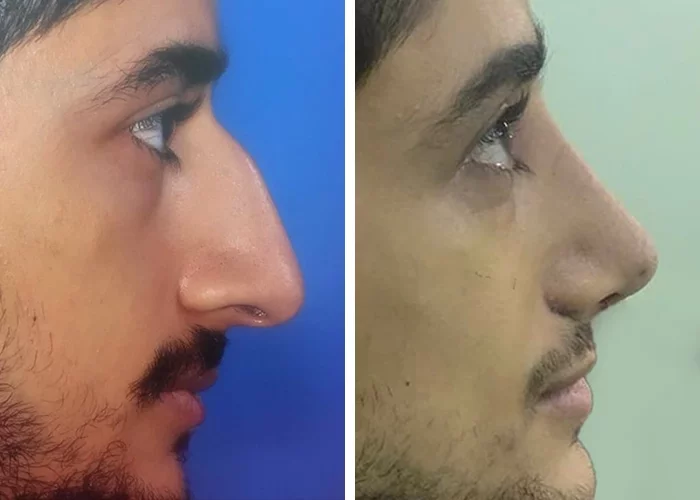 before & after photo of عمل زیبایی بینی