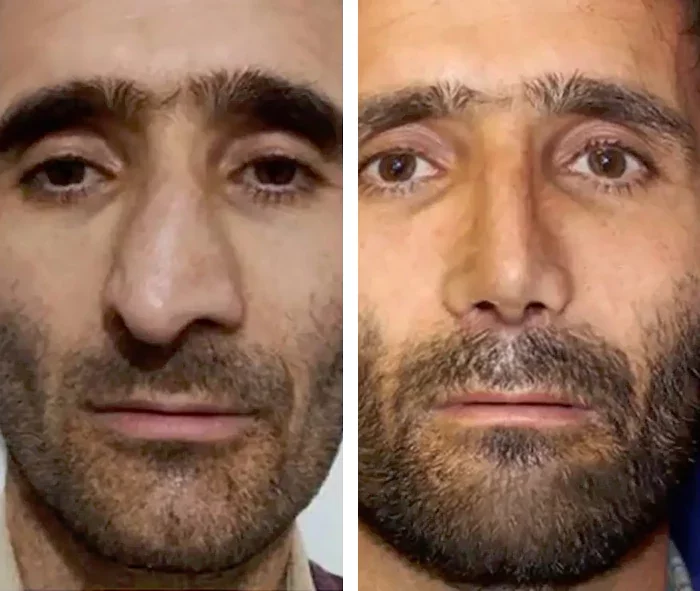 before & after photo of عمل زیبایی بینی