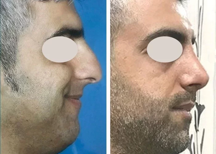 before & after photo of عمل زیبایی بینی