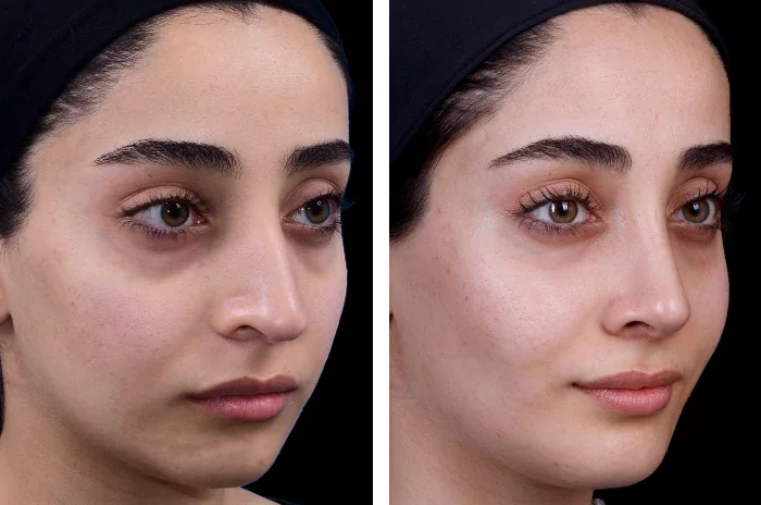 before & after photo of جراحی پروتز چانه و فک