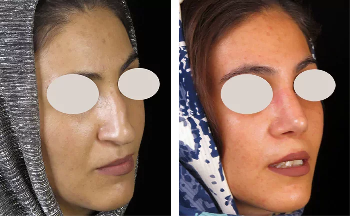 before & after photo of عمل زیبایی بینی