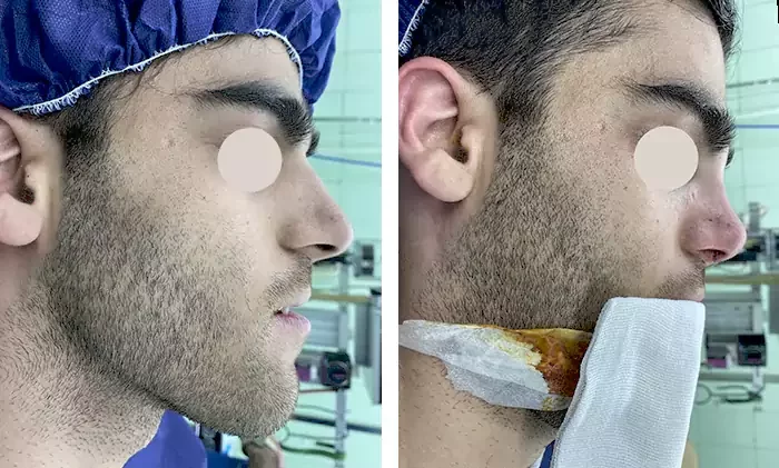 before & after photo of عمل زیبایی بینی