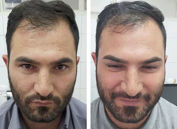 before & after photo of بوتاکس