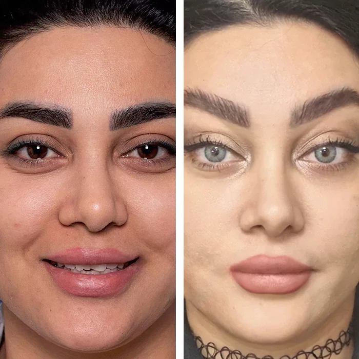 لیفت شقیقه عکس