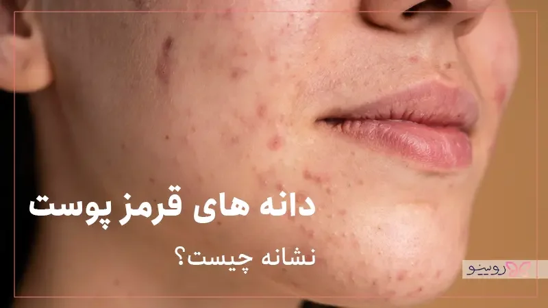 دانه های قرمز روی پوست نشانه چیست؟ انواع و درمان