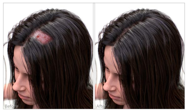 ریزش موی زخمی before and after