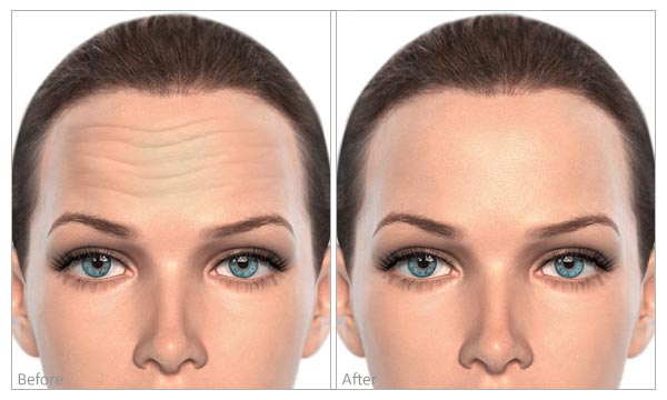 Fine Lines & Wrinkles (forehead) before and after