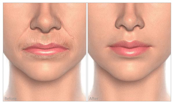 Fine Lines & Wrinkles (lips) before and after