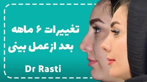 تغییرات جراحی بینی ۶ ماه بعد از عمل