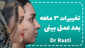 تغییرات بینی گوشتی ۳ ماه بعد از جراحی بینی